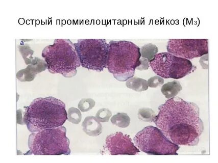 Острый промиелоцитарный лейкоз по утвержденным клиническим рекомендациям