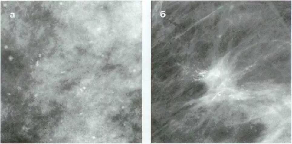 Маммография микрокальцинаты. Кальцинаты на маммографии. Склерозирующий аденоз молочной железы на рентгене. Диффузный аденоз