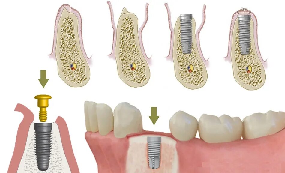 Зубы импланты поэтапно. Формирователь десны на имплант что такое. Этапы имплантации зубов. Имплантация зубов хирургический этап.