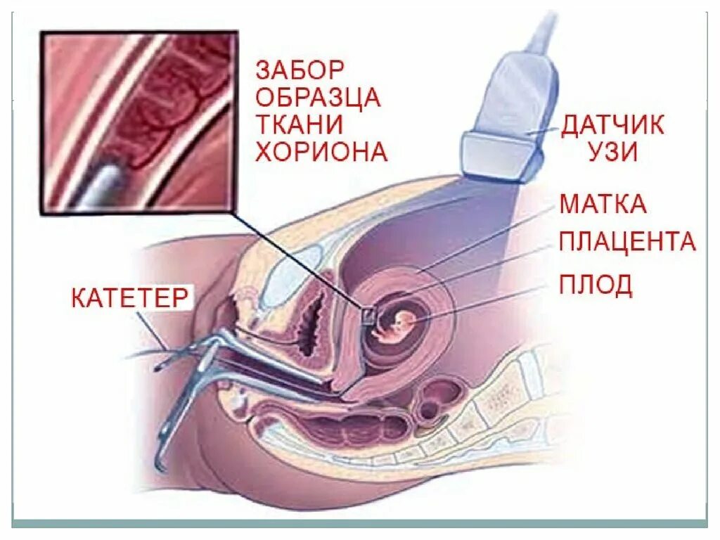 Биопсия хориона это. Трансабдоминальная биопсия хориона. трансабдоминальная биопсия ворсин хориона. пренатальная диагностика биопсия хориона. трансцервикальная биопсия ворсин хориона.