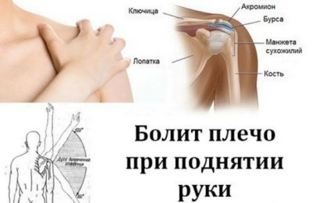 Резкая сильная боль в плечевом суставе. Рука болит в плечевом суставе. Болит плечо при поднятии руки.