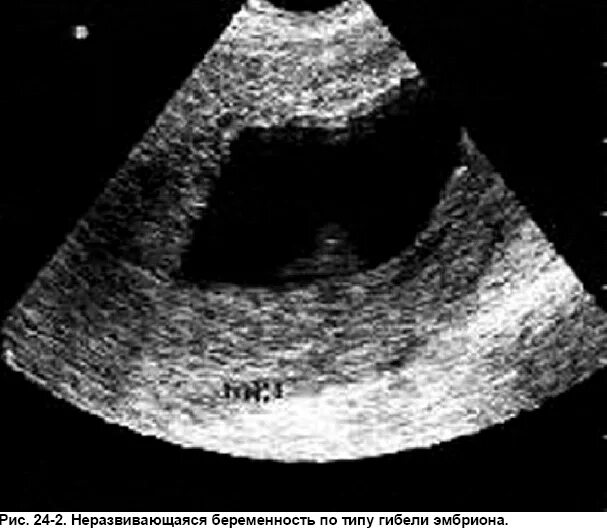 11 замерших беременностей