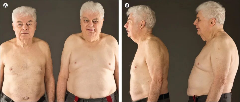 Гипогонадизм гинекомастия. Недостаточность тестостерона у мужчин. Метаболический синдром клинические рекомендации. Синдром тестостерона. Первичный гипогонадизм симптомы.