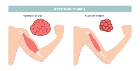 Недостаточная мышечная активность