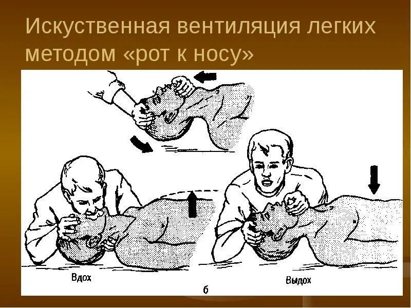 Искуственная вентиляция легких алгоритм кратко