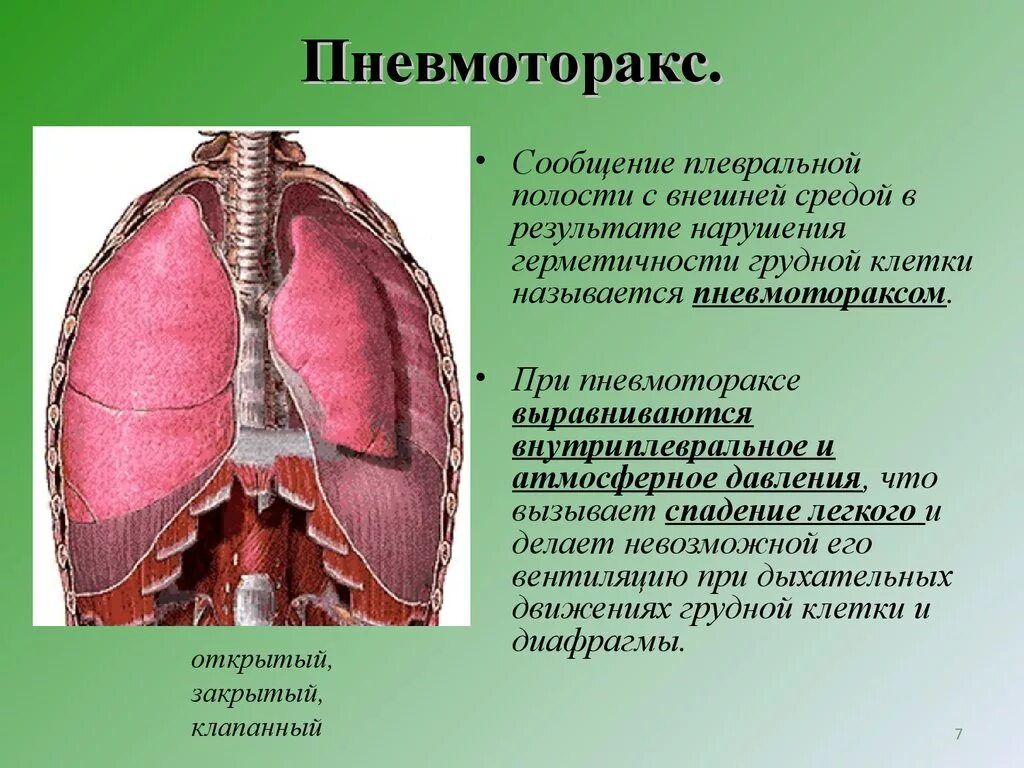 Попадание воздуха в полость. Пневмоторакс спадение легкого. Ранение в грудную клетку пневмоторакс. Пневмоторакс при ранении грудной клетки. Механизм дыхания при пневмотораксе.