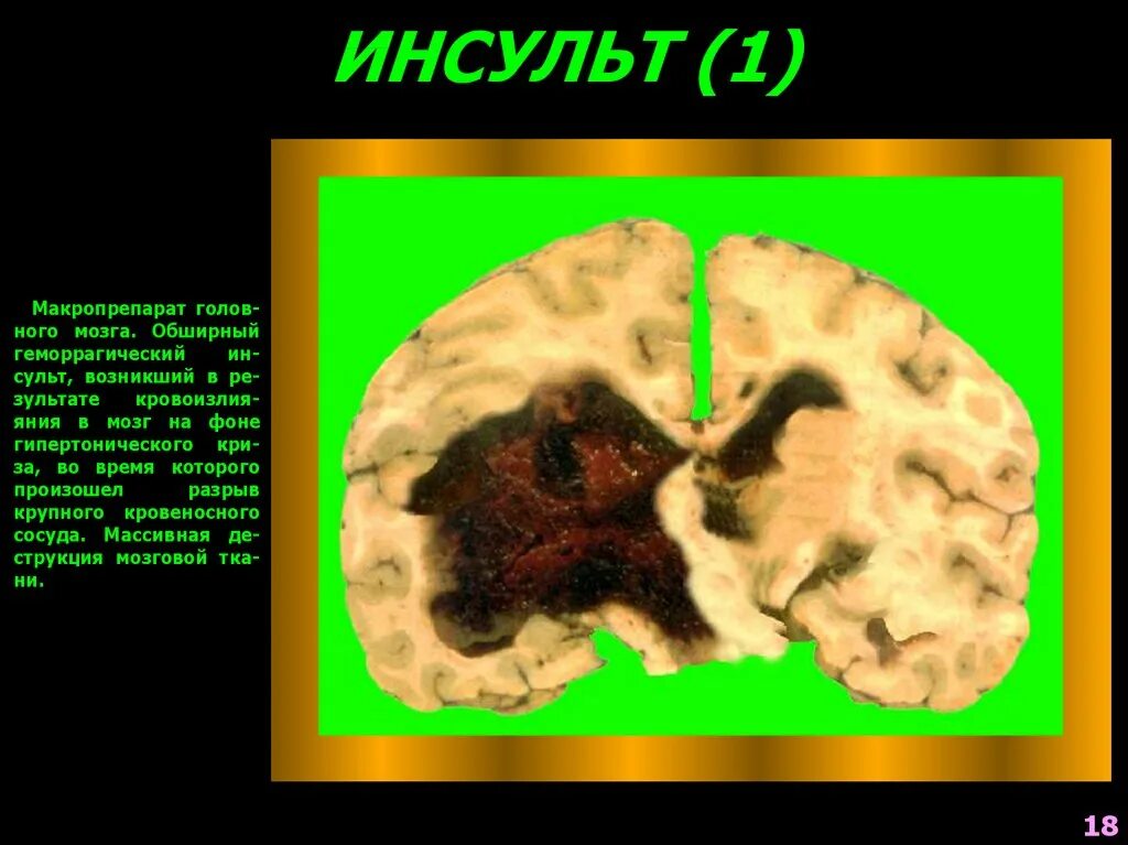 Шансы выжить после инсульта. Кровоизлияние в головной мозг макропрепарат. Геморрагический инсульт головного мозга макропрепарат. Ишемический инфаркт мозга макропрепарат. Инсульт головного мозга макропрепарат.