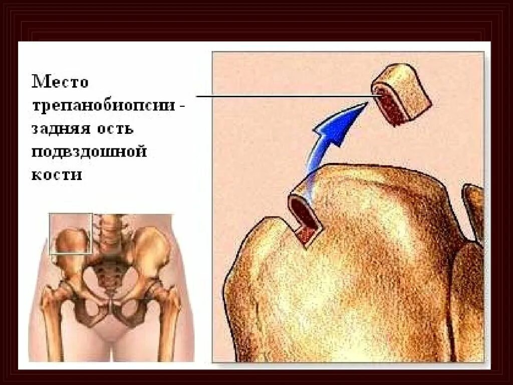 Трепанобиопсия подвздошной. Биопсия подвздошной кости. Трансплантация костного мозга. Биопсия из подвздошной кости. Трипанобиопсия подзвешенной кости.