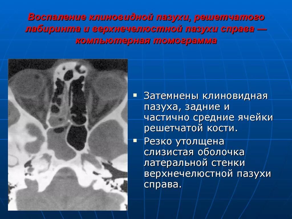 Локальное утолщение слизистой. Пазухи клиновидной кости на кт. Анатомия клеток решетчатого Лабиринта на кт. Воспаление клиновидной пазухи. Утолщение слизистой оболочки клиновидной пазухи.