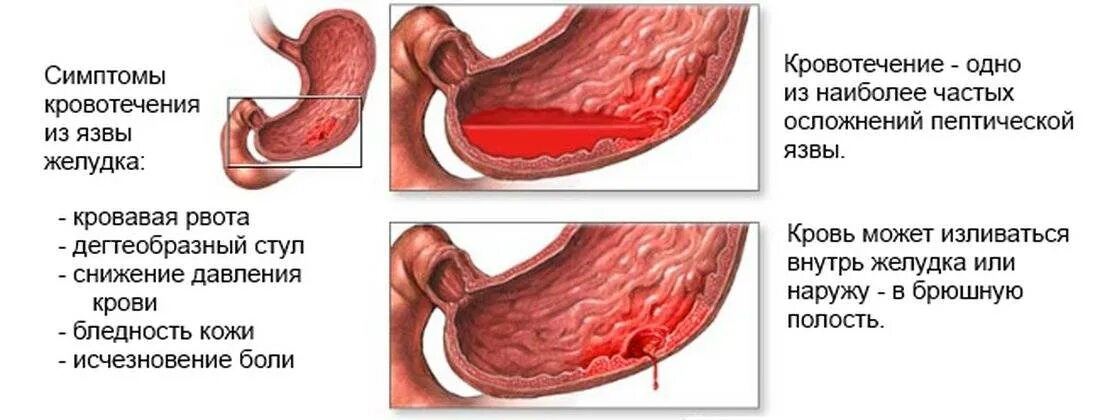 Язвенная болезнь желудка симптомы. Осложнения язвенной болезни желудка. Характерные симптомы язвенной болезни. Основные симптомы язвенной болезни желудка и 12-перстной кишки. Боли при язвенной болезни 12 перстной кишки.