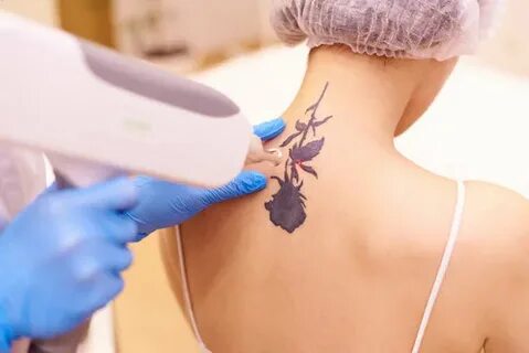 Advanced Laser Tattoo Removal Riyadh