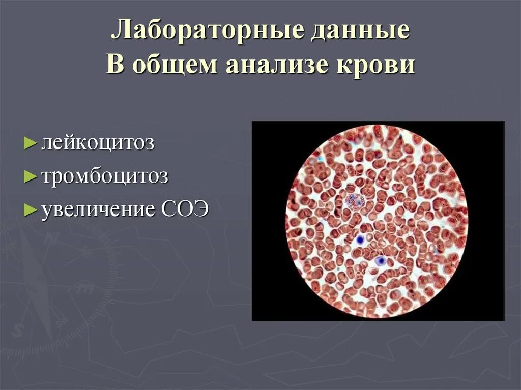 Лейкоцитоз увеличение соэ. Эссенциальная тромбоцитемия. Эссенциальный тромбоцитоз. Первичный тромбоцитоз. Тромбоцитемии презентация.