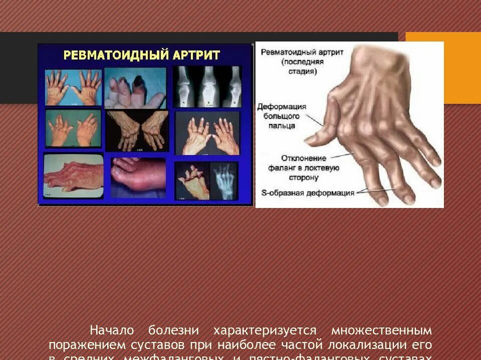 Ревматоидный артрит это. Ревматоидный артрит характеризуется. Ревматоидный артрит поражение внутренних органов. Органы мишени при ревматоидном артрите. Ревматический артрит локализация.