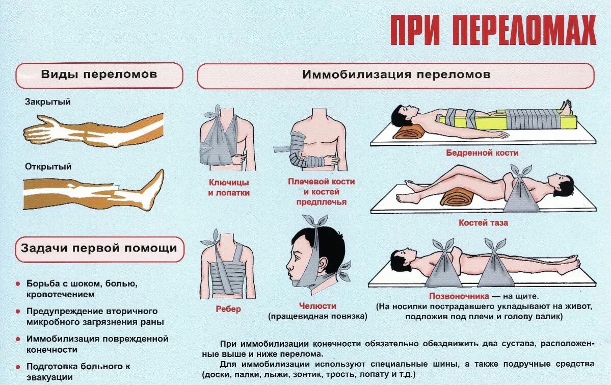 Помощь при переломах конечностей. Помощь при переломах конечностей