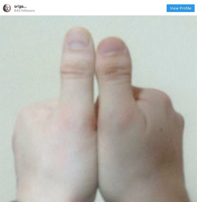 Брахидактилия (короткопалость). Почему большие пальцы. Брахидактилия фаланги. Почему большие пальцы. Почему большие пальцы.