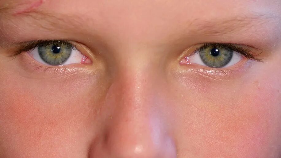 Коньюктивит у ребенка 7. Аллергический конъюнктивит. Припухлость под глазами у ребенка. Аллергические глаза у детей.