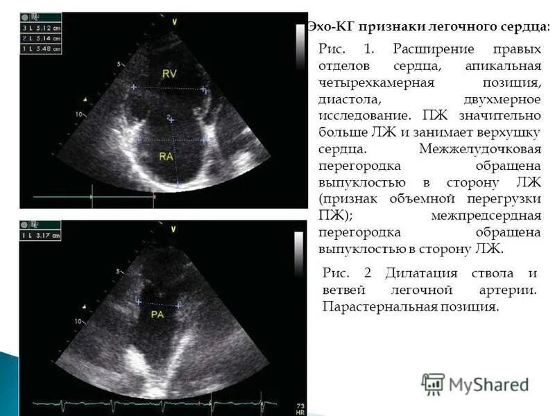 Как найти эхо. ЭХОКГ признаки легочного сердца. ЭХОКГ при хроническом легочном сердце. Расширение правых отделов сердца. ЭХОКГ при ХЛС.