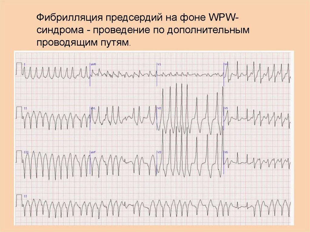 Пароксизмальная фибрилляция предсердий на ЭКГ. Фибрилляция предсердий Мерцательная аритмия ЭКГ. Трепетание предсердий 1 к 1 на ЭКГ. Пароксизм трепетания предсердий ЭКГ. Формы трепетания предсердий