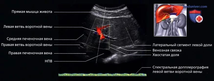 Анатомия вен печени на УЗИ. Печеночные вены анатомия УЗИ. Ультразвуковая анатомия печени сегменты. Печеночные вены норма на УЗИ. Узи печени схема
