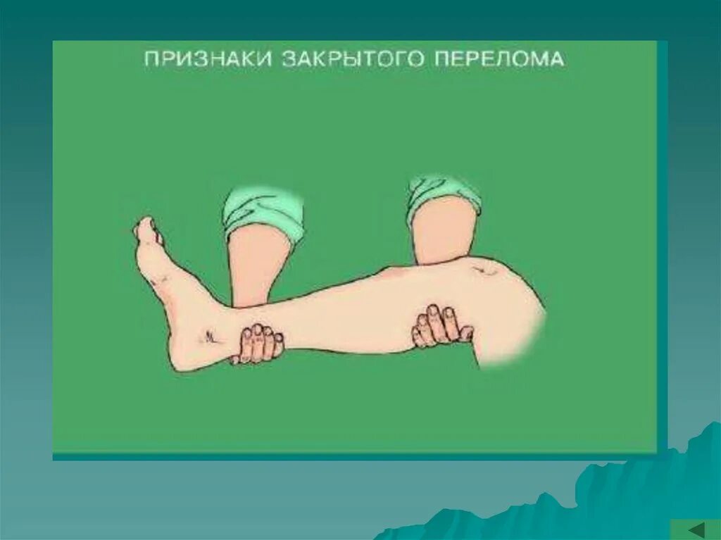 Закрытый перелом это. Признаки закрытого перелома. назовите признаки закрытого перелома. симптомы закрытого перелома кости. открытый и закрытый перелом симптомы.