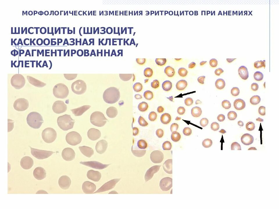 Анемия шизоциты. Шизоциты в мазке. Эритроциты шизоциты. Морфологические изменения эритроцитов.