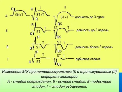 Трансмуральный инфаркт