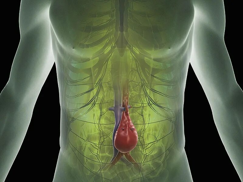 Аневризма брюшной полости. Аневризм брюшной полости. Аневризма внутренних органов.