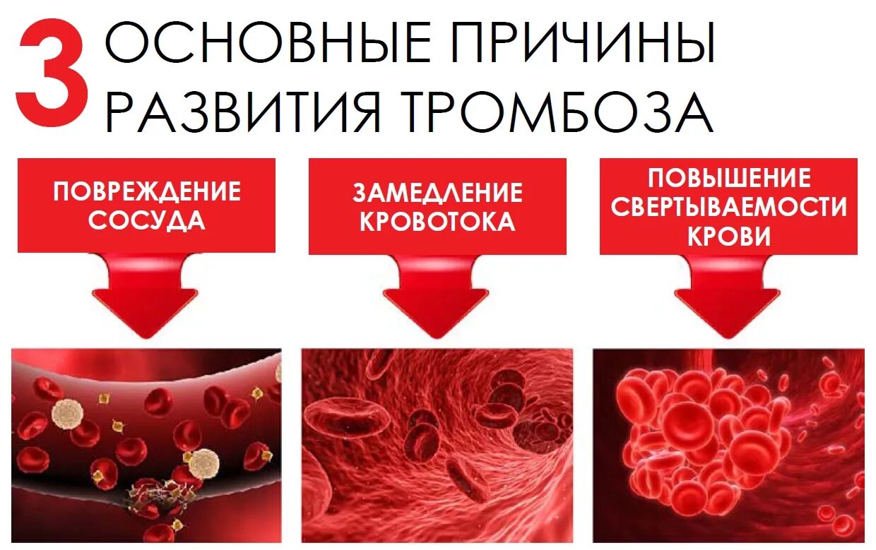 Тромбоз возникновение. Тромб причины образования. Тромбоз причины возникновения. Факторы образования тромба.