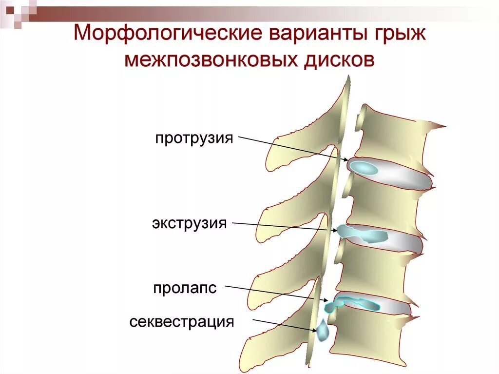 Спинные диски. Экструзия с4-с5 диска. Протрузии экструзии межпозвонковых дисков. Протрузия грыжа межпозвонковых дисков. Экструзия диска шейного отдела.