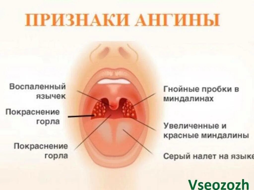 Во рту температура без. Ангина лакунарная катаральная.