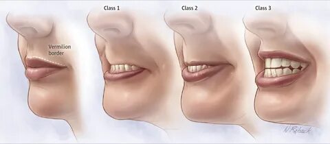 Upper Lip Bite Test Score Ownerlip.co.