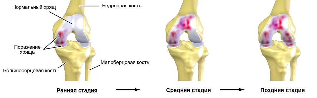 3 й стадии. Гонартроза 2 степени коленного сустава. Артроз 3й степени коленного сустава. Деформирующий остеоартроз коксартроз гонартроз. Гонартроз 1 степени коленного сустава что это такое.