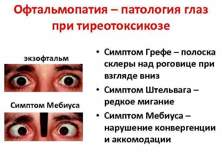 Экзофтальм наблюдается при. Симптом Грефе тиреотоксикоз. Симптомы Грефе, Мебиуса, кохера. Симптомы Грефе Мебиуса кохера Штельвага. Глазные симптомы Грефе Мебиуса.