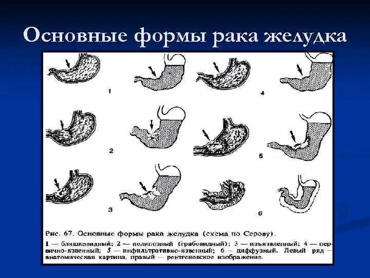 Ковид желудка. Эндофитный рост опухоли желудка. Экзофитная опухоль желудка рентген. Классификация желудка.