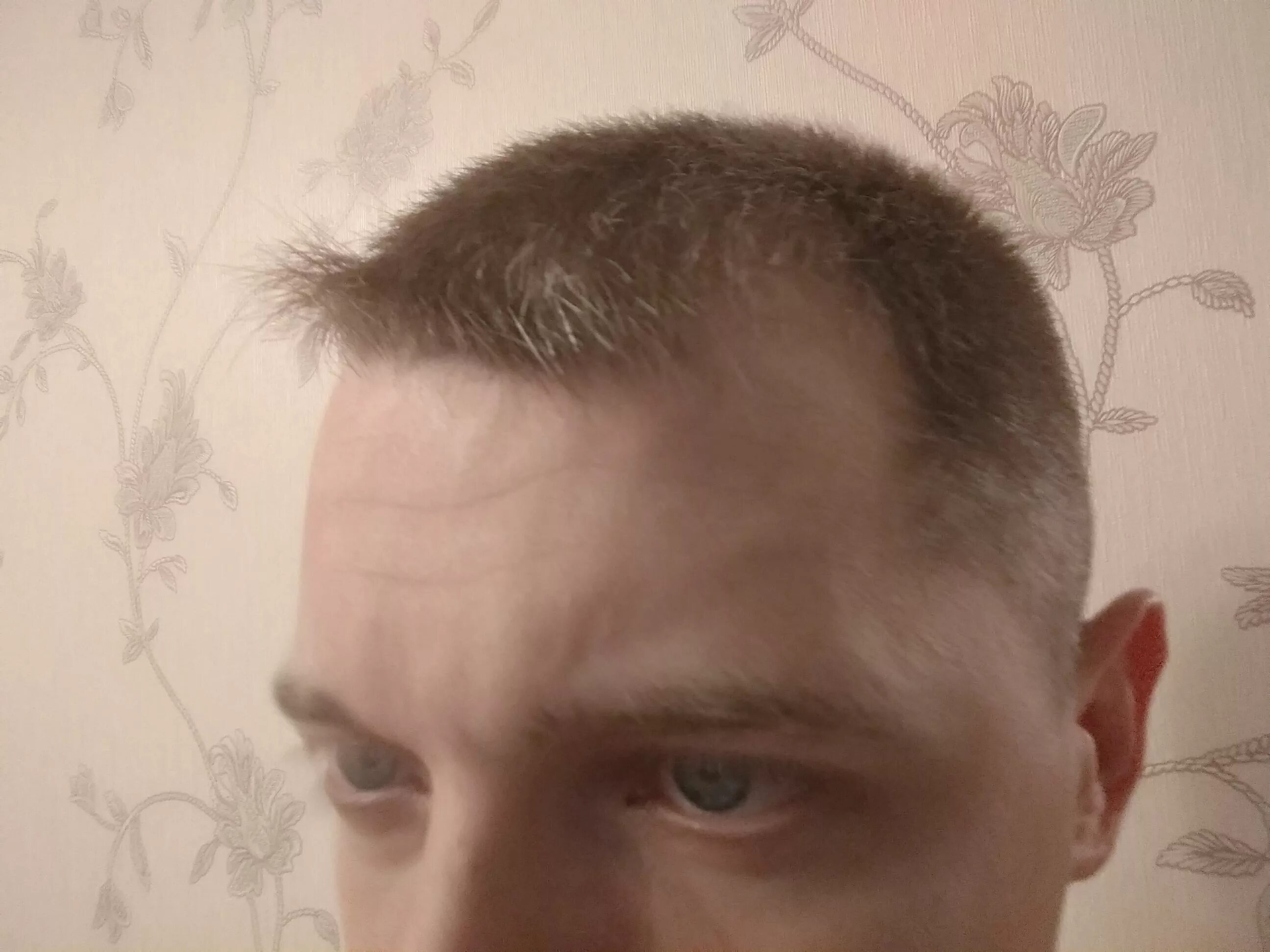 Как убрать вихор. Прическа с вихром на челке у женщин. Как убрать вихор. Лобные залысины у женщин. Как убрать вихор.