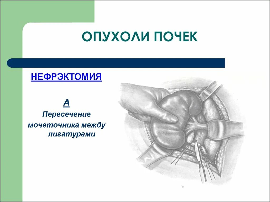 Операция нефрэктомия этапы операции. Радикальная нефрэктомия. Лапароскопическая нефрэктомия этапы операции. Операция нефрэктомия топографическая анатомия. Резекция почки что это