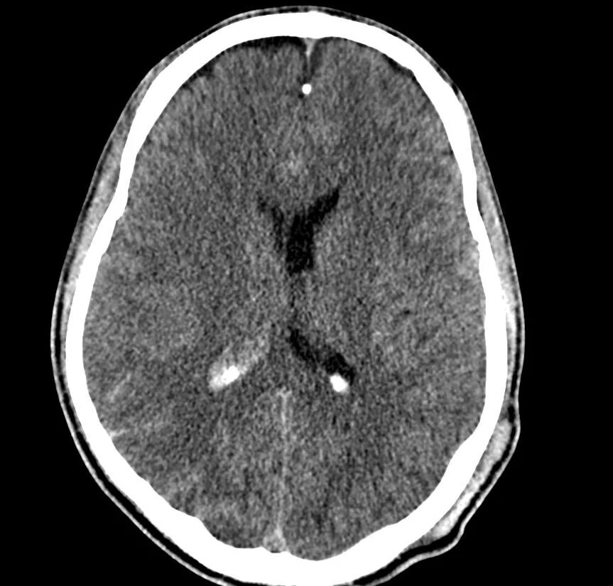 Диффузное аксональное повреждение мозга кт. Диффузно аксональные повреждения головного мозга кт. Диффузное аксональное повреждение головного мозга ЧМТ. Диффузная травма
