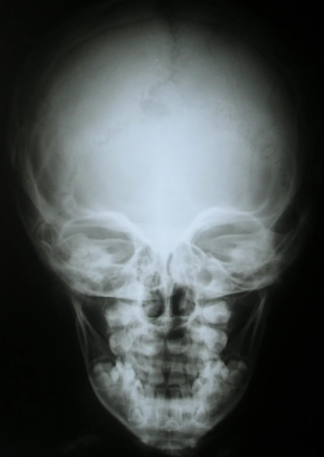 Ахондроплазия рентген черепа. Рентгенография черепа ребенка. Рентген черепа новорожденного.