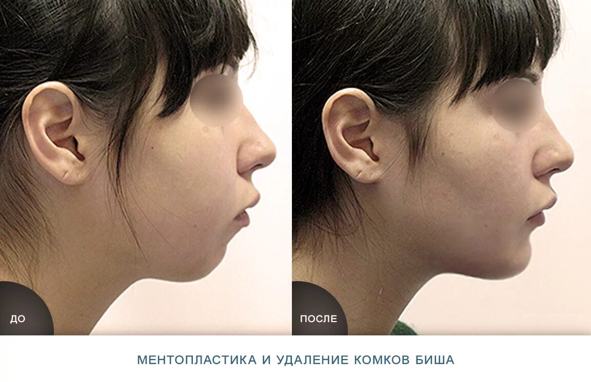 Лицо бишки. Эдисон перец 2022 год на стриме. Дженис дикинсон биша. Пластика подбородка фото до и после. Лицо бишки.