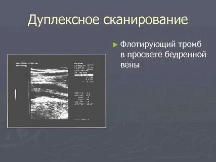 Флотирующий тромб нижней конечности