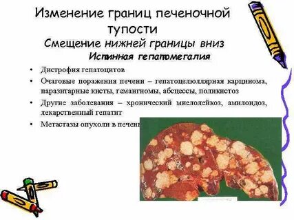 Отсутствие печеночной тупости