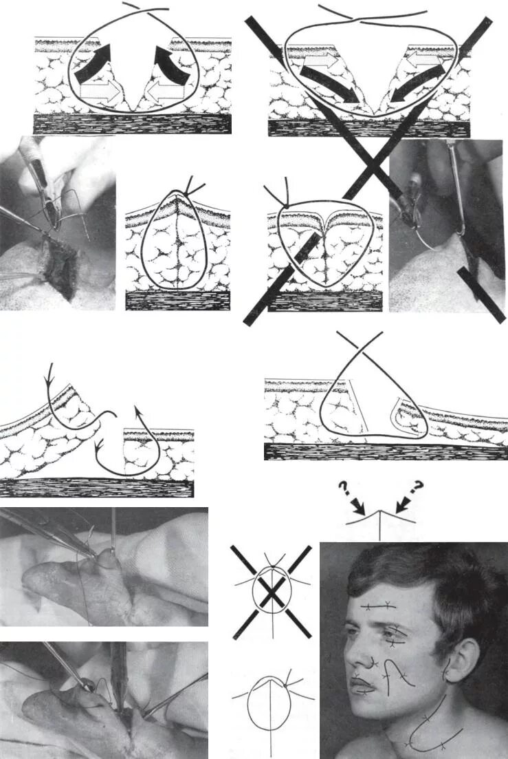 Техника наложения хирургических швов