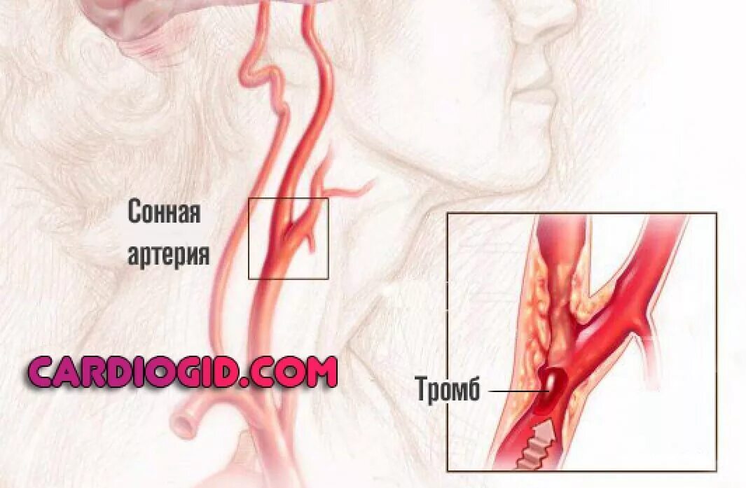Тромбоз шейной артерии. Признаки тромбоза сонной артерии. Тромбоз лобной артерии. Ишемия нерва