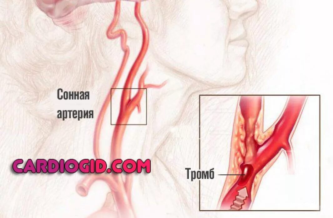 Артерия тромб удаление
