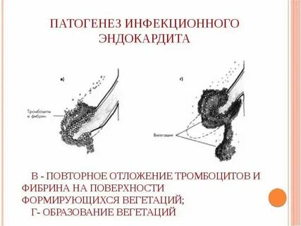 Инфекции эндокардит клинические