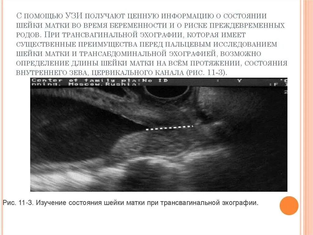 Что значит расширенная полость матки. Ультразвуковое исследование матки при беременности. Ультразвуковое исследование шейки матки УЗИ-цервикометрия. Шейка матки цервикометрия.