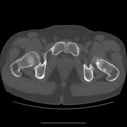 Кт подвздошной кости. Эностоз кости кт. Остеома костей таза кт. Эностоз шейки бедренной кости кт. Костный островок на кт.