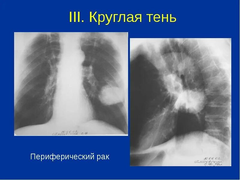 Синдром очаговых теней в легких. Синдром круглой тени в легком. Круглая тень легкого. Синдром круглой тени на рентгенограмме. Круглая тень легкого.