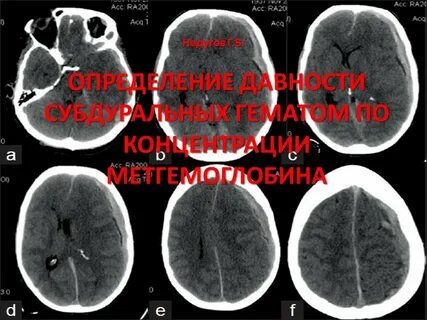 Давность субдуральной гематомы