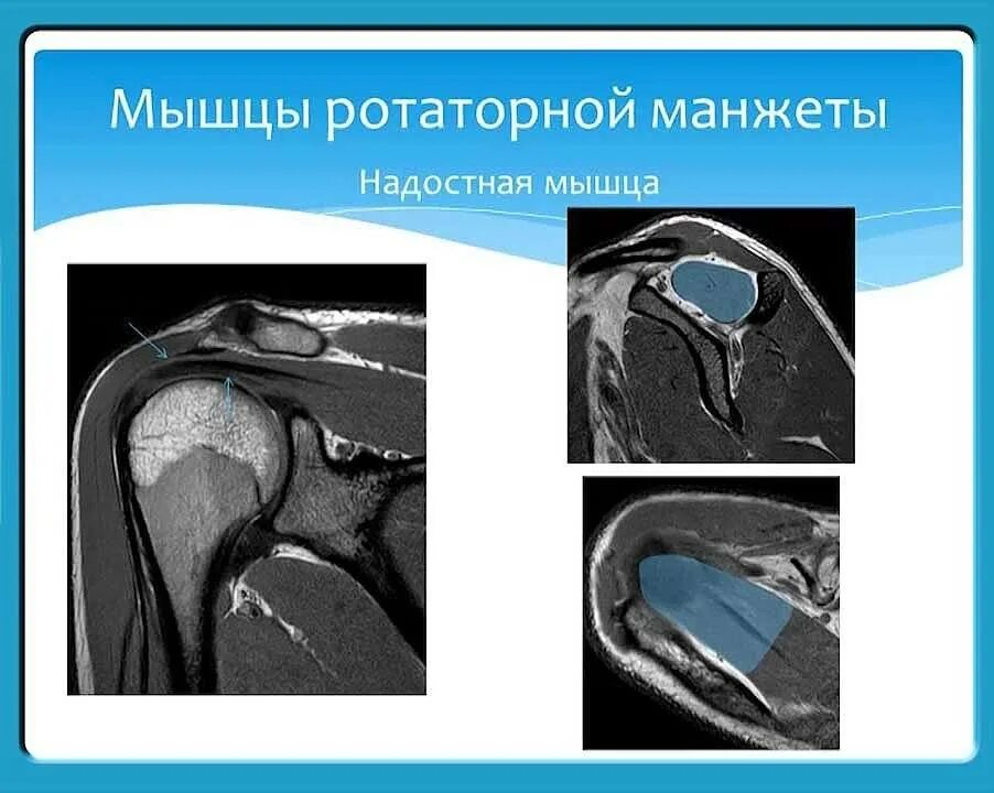 Ротаторная манжета плечевого сустава мрт. Повреждение ротаторная манжета. Частичный разрыв сухожилия надостной мышцы плечевого сустава на мрт. Повреждение вращательной манжеты плечевого сустава мрт.